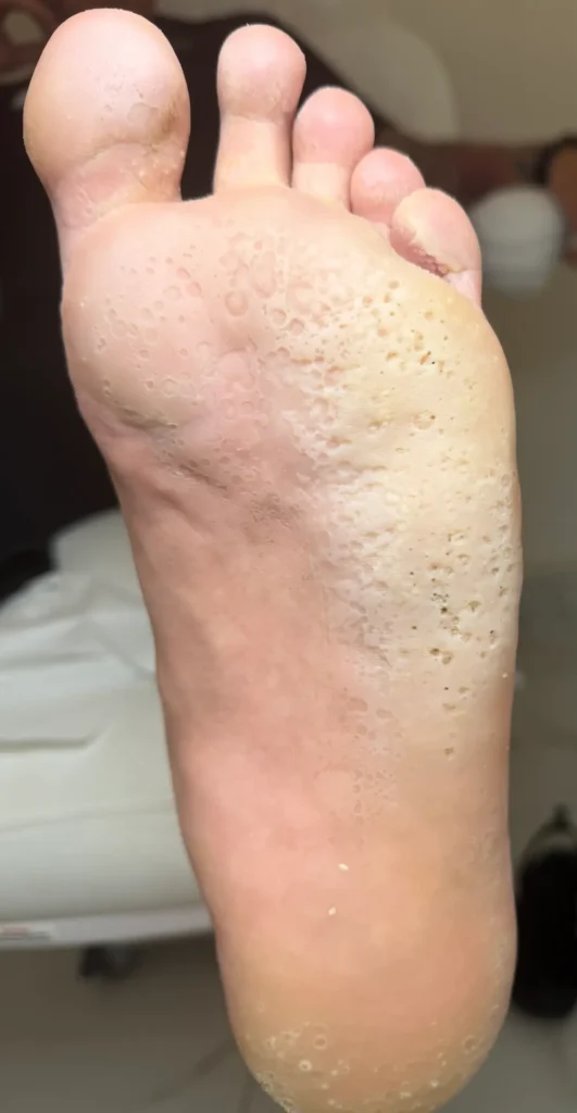 Keratoliza dziobata przed opracowaniem