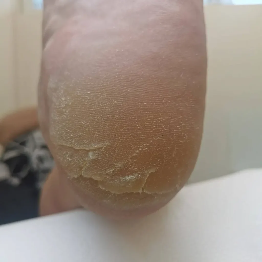 pękające pięty Łódź leczenie przed gabinet Jak Marzenie